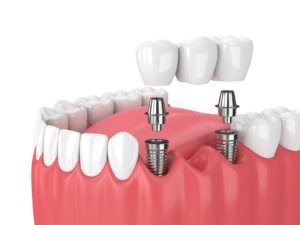 tooth replacement Bensalem Pennsylvania