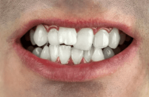 Crooked Teeth and Oral Health
