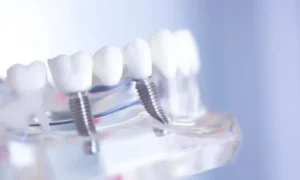 The Benefits of Dental Implants For Tooth Loss in Bensalem, PA