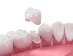 CEREC Crowns vs. Traditional Crowns in Bensalem, PA